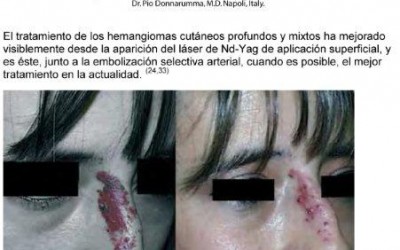 TRATAMIENTO CON LÁSER Y IPL HEMANGIOMAS CUTÁNEOS Y LESIONES VASCULARES BENIGNAS