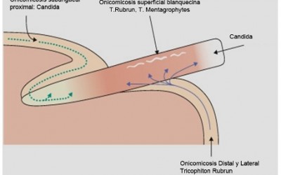 TRATAMIENTO DE LA ONICOMICOSIS CON IPL (Resumen de Estudio Realizado)