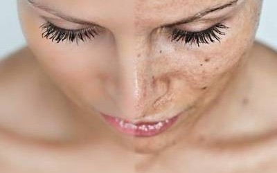 MELASMA, Un problema estético para quien lo padece.       Hoy Iniciamos un pequeño programa en el que vamos a explicar varias formas de solucionar       EL MELASMA.