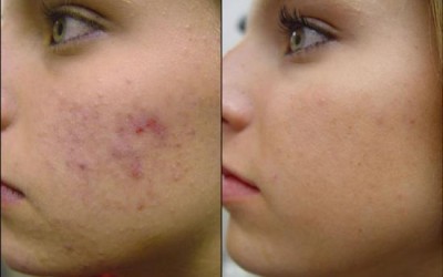 TRATAMIENTO DEL ACNE CON IPL