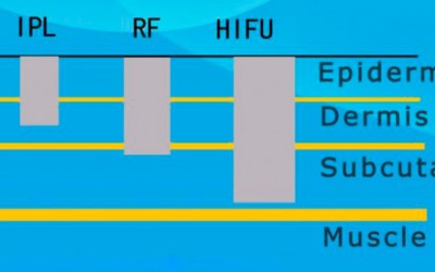 NDV HIFU FACIAL  –  Facial Lifting and Tightening without a surgery