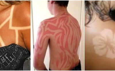 ‘Sunburn Art’, la peligrosa moda de tatuarse con quemaduras solares