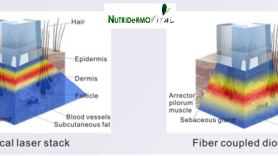 Láser diodo de barrido de transmisión por fibra óptica NDV FiberLaser de Diodo