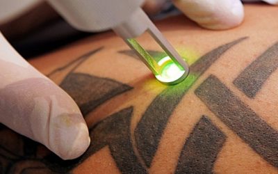 ¿Se puede volver a tatuar en el lugar de un tatuaje borrado y Es seguro tatuarse en el mismo lugar en donde eliminamos un tatuaje?