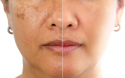 El tratamiento del melasma con la óptica fraccionada de Láser Picosegundo 1064nm una opción mas segura (minimiza la hipopigmentación)