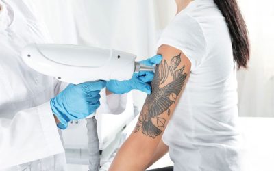 El Arte de Deshacer el Arte: Cómo Funciona la Eliminación de Tatuajes con Láser