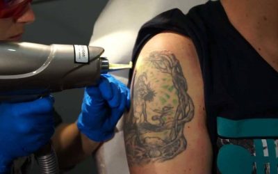 Estudio: La luz láser en la eliminación de tatuajes: ¿un riesgo oculto?