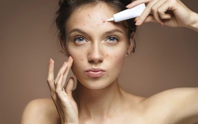 Cuidado de la piel con acné: Recomendaciones esenciales para profesionales de la estética