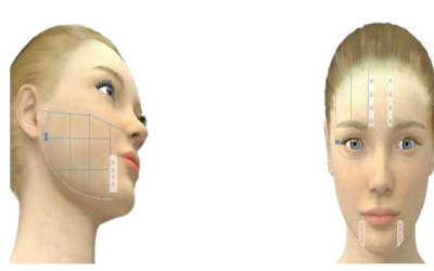 Aplicación HIFU facial ¿Por qué dibujar áreas de aplicación?